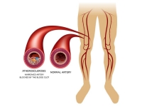 perifeer-arterieel-vaatlijden